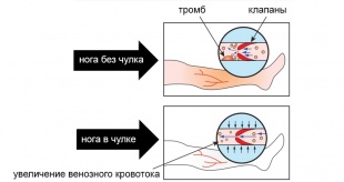 Чулки антиэмболические 2 класс Ergoforma (арт. 227) фото 2703